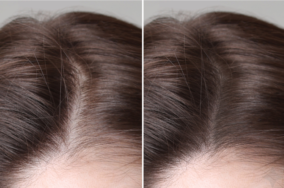 Before and after hair restoration treatment - Female, 45 — After 4 Sessions