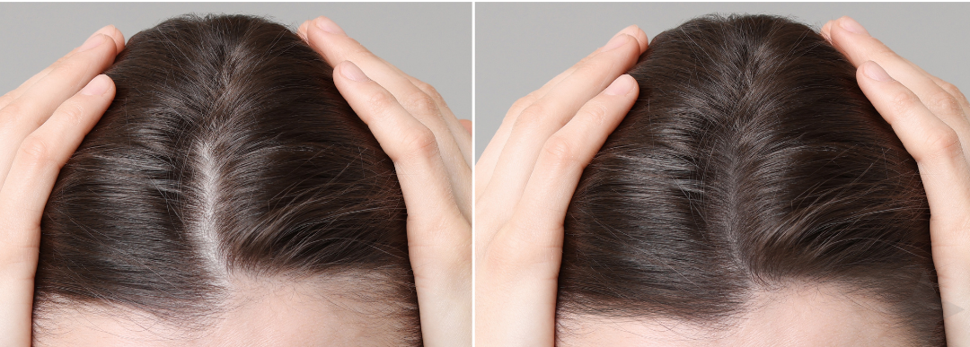 Before and after hair restoration treatment - Female, 51 — After 6 Sessions